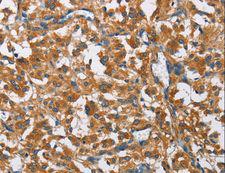 COPB1 / Beta-COP Antibody - Immunohistochemistry of paraffin-embedded Human thyroid cancer using COPB1 Polyclonal Antibody at dilution of 1:50.
