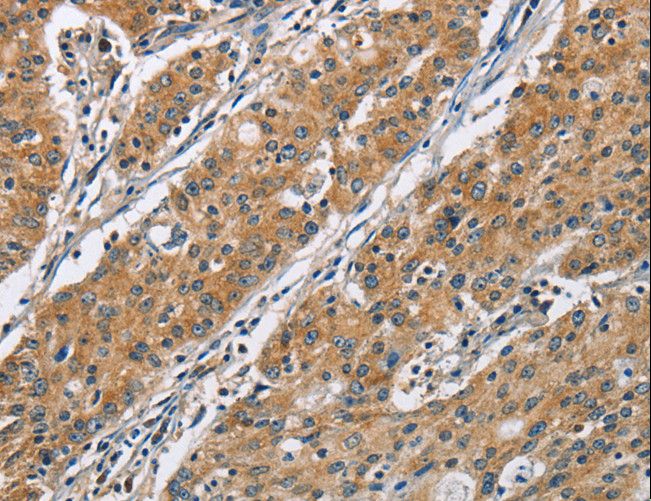 COPB1 / Beta-COP Antibody - Immunohistochemistry of paraffin-embedded Human gastric cancer using COPB1 Polyclonal Antibody at dilution of 1:50.