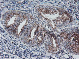 COPD / ARCN1 Antibody - IHC of paraffin-embedded Adenocarcinoma of Human endometrium tissue using anti-ARCN1 mouse monoclonal antibody.