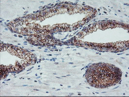 COPD / ARCN1 Antibody - IHC of paraffin-embedded Carcinoma of Human prostate tissue using anti-ARCN1 mouse monoclonal antibody.
