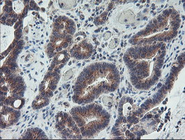 COPD / ARCN1 Antibody - IHC of paraffin-embedded Adenocarcinoma of Human colon tissue using anti-ARCN1 mouse monoclonal antibody.