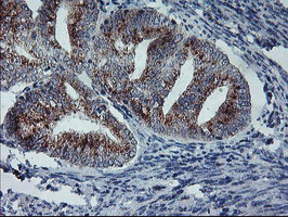 COPD / ARCN1 Antibody - IHC of paraffin-embedded Adenocarcinoma of Human endometrium tissue using anti-ARCN1 mouse monoclonal antibody.