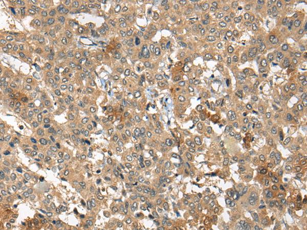 COPD / ARCN1 Antibody - Immunohistochemistry of paraffin-embedded Human liver cancer tissue  using ARCN1 Polyclonal Antibody at dilution of 1:50(×200)