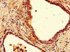 COPE Antibody - Immunohistochemistry of paraffin-embedded human prostate cancer using COPE Antibody at dilution of 1:100