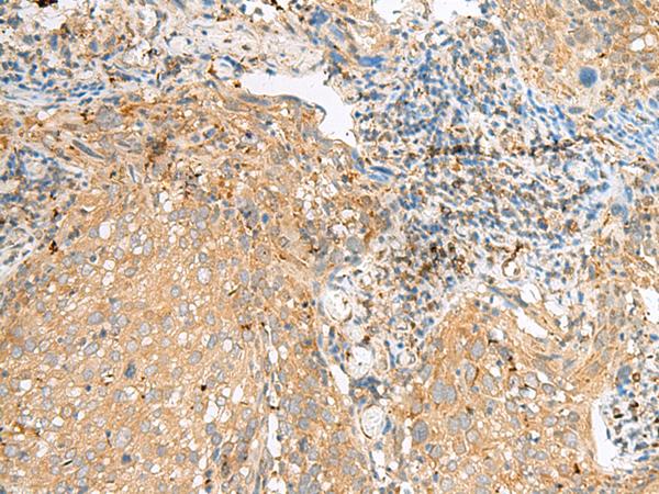 COPE Antibody - Immunohistochemistry of paraffin-embedded Human cervical cancer tissue  using COPE Polyclonal Antibody at dilution of 1:50(×200)
