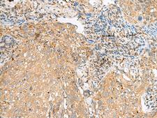 COPE Antibody - Immunohistochemistry of paraffin-embedded Human cervical cancer tissue  using COPE Polyclonal Antibody at dilution of 1:50(×200)
