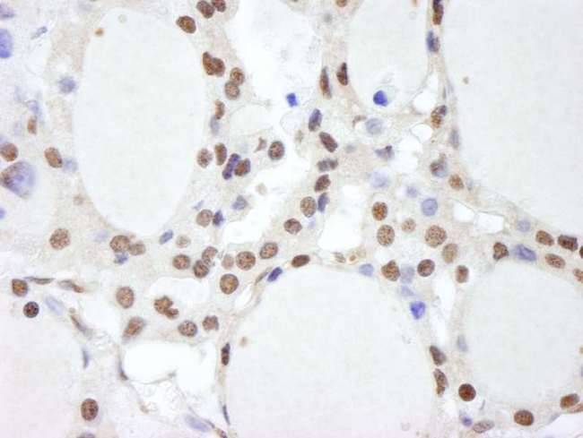 COPS2 / TRIP15 / ALIEN Antibody - Detection of Human CSN2 by Immunohistochemistry. Sample: FFPE section of human anaplastic thyroid carcinoma. Antibody: Affinity purified rabbit anti-CSN2 used at a dilution of 1:500.