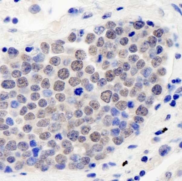 COPS3 / CSN3 Antibody - Detection of Human CSN3 by Immunohistochemistry. Sample: FFPE section of human small cell lung cancer. Antibody: Affinity purified rabbit anti-CSN3 used at a dilution of 1:250. Detection: DAB staining using IHC Accessory Kit.