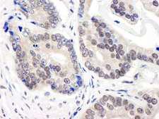 COPS3 / CSN3 Antibody - Detection of Human CSN3 by Immunohistochemistry. Sample: FFPE section of human prostate carcinoma. Antibody: Affinity purified rabbit anti-CSN3 used at a dilution of 1:1000 (1 ug/ml). Detection: DAB.