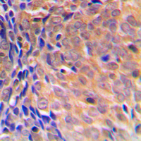 COPS3 / CSN3 Antibody - Immunohistochemical analysis of COPS3 staining in human breast cancer formalin fixed paraffin embedded tissue section. The section was pre-treated using heat mediated antigen retrieval with sodium citrate buffer (pH 6.0). The section was then incubated with the antibody at room temperature and detected using an HRP conjugated compact polymer system. DAB was used as the chromogen. The section was then counterstained with hematoxylin and mounted with DPX.