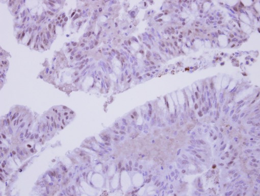 COPS3 / CSN3 Antibody - IHC of paraffin-embedded Colon ca, using COPS3 antibody at 1:250 dilution.