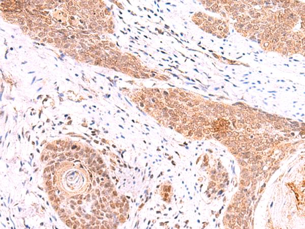 COPS3 / CSN3 Antibody - Immunohistochemistry of paraffin-embedded Human esophagus cancer tissue  using COPS3 Polyclonal Antibody at dilution of 1:60(×200)