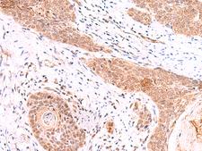 COPS3 / CSN3 Antibody - Immunohistochemistry of paraffin-embedded Human esophagus cancer tissue  using COPS3 Polyclonal Antibody at dilution of 1:60(×200)