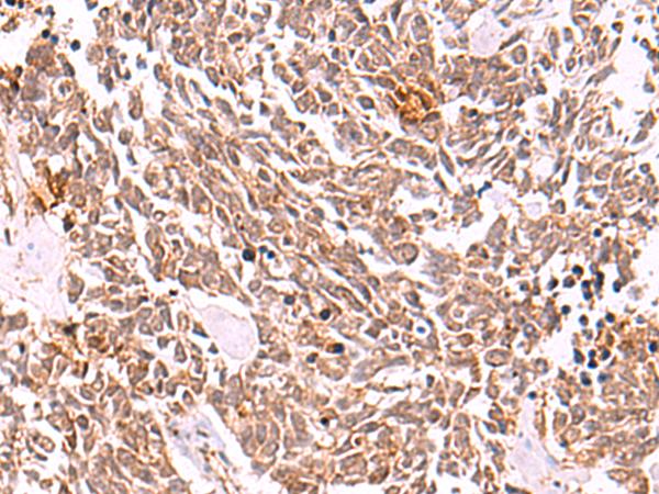 COPS3 / CSN3 Antibody - Immunohistochemistry of paraffin-embedded Human lung cancer tissue  using COPS3 Polyclonal Antibody at dilution of 1:50(×200)