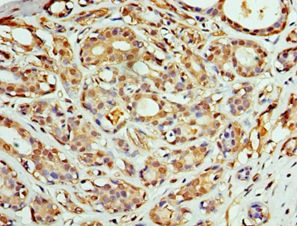 COPS4 / CSN4 Antibody - Immunohistochemistry of paraffin-embedded human breast cancer using antibody at 1:100 dilution.