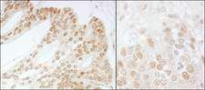 COPS5 / JAB1 Antibody - Detection of Human and Mouse CSN5 by Immunohistochemistry. Sample: FFPE section of human prostate carcinoma (left) and mouse teratoma (right). Antibody: Affinity purified rabbit anti-CSN5 used at a dilution of 1:500 (2 ug/ml). Detection: DAB.