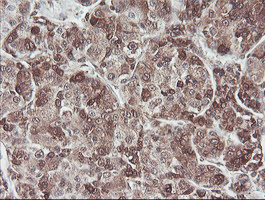 COPS5 / JAB1 Antibody - IHC of paraffin-embedded Carcinoma of Human liver tissue using anti-COPS5 mouse monoclonal antibody.