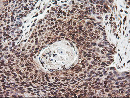 COPS5 / JAB1 Antibody - IHC of paraffin-embedded Carcinoma of Human bladder tissue using anti-COPS5 mouse monoclonal antibody.