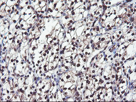 COPS5 / JAB1 Antibody - IHC of paraffin-embedded Carcinoma of Human kidney tissue using anti-COPS5 mouse monoclonal antibody.