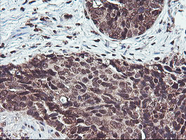 COPS5 / JAB1 Antibody - IHC of paraffin-embedded Carcinoma of Human lung tissue using anti-COPS5 mouse monoclonal antibody.