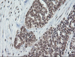 COPS5 / JAB1 Antibody - IHC of paraffin-embedded Adenocarcinoma of Human ovary tissue using anti-COPS5 mouse monoclonal antibody.
