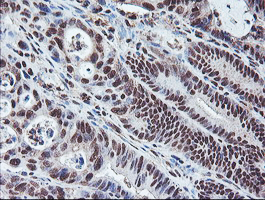COPS5 / JAB1 Antibody - IHC of paraffin-embedded Carcinoma of Human pancreas tissue using anti-COPS5 mouse monoclonal antibody.