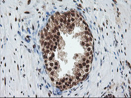 COPS5 / JAB1 Antibody - IHC of paraffin-embedded Carcinoma of Human prostate tissue using anti-COPS5 mouse monoclonal antibody.