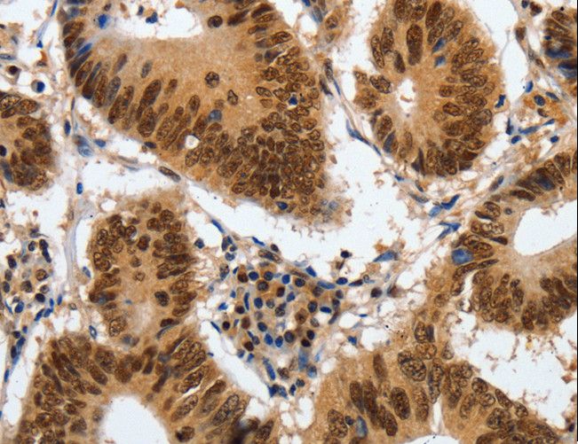 COPS5 / JAB1 Antibody - Immunohistochemistry of paraffin-embedded Human colon cancer using COPS5 Polyclonal Antibody at dilution of 1:120.