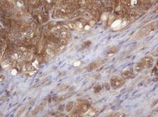COPS6 / CSN6 Antibody - IHC of paraffin-embedded Adenocarcinoma of Human colon tissue using anti-COPS6 mouse monoclonal antibody.