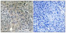 COPZ1 Antibody - Immunohistochemistry analysis of paraffin-embedded human cervix carcinoma tissue, using COPZ1 Antibody. The picture on the right is blocked with the synthesized peptide.
