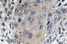 COPZ1 Antibody - IHC of COP 1 (I48) pAb in paraffin-embedded human cervix carcinoma tissue.