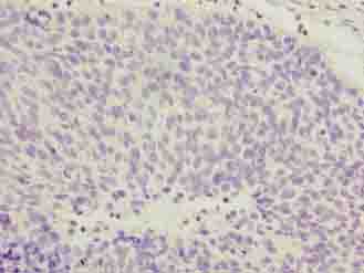 COPZ1 Antibody - Immunohistochemistry of paraffin-embedded human cervical cancer using antibody at dilution of 1:100.