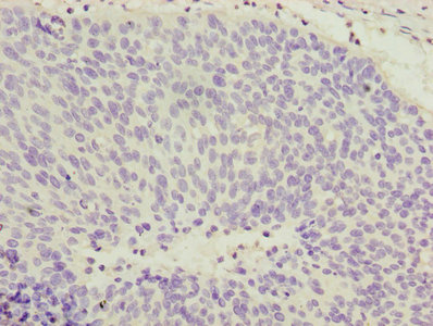 COPZ1 Antibody - Immunohistochemistry of paraffin-embedded human cervical cancer using COPZ1 Antibody at dilution of 1:100