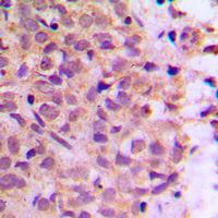 COPZ1 Antibody - Immunohistochemical analysis of Zeta COP staining in human breast cancer formalin fixed paraffin embedded tissue section. The section was pre-treated using heat mediated antigen retrieval with sodium citrate buffer (pH 6.0). The section was then incubated with the antibody at room temperature and detected using an HRP conjugated compact polymer system. DAB was used as the chromogen. The section was then counterstained with hematoxylin and mounted with DPX.