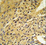 COQ5 Antibody - COQ5 Antibody IHC of formalin-fixed and paraffin-embedded human lung carcinoma followed by peroxidase-conjugated secondary antibody and DAB staining.