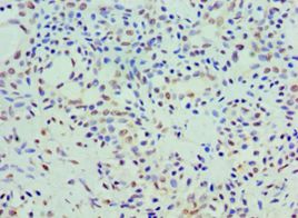 COQ7 Antibody - Immunohistochemistry of paraffin-embedded human breast cancer using antibody at 1:100 dilution.