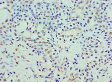 COQ7 Antibody - Immunohistochemistry of paraffin-embedded human breast cancer using antibody at 1:100 dilution.