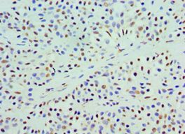 COQ7 Antibody - Immunohistochemistry of paraffin-embedded human breast cancer using antibody at 1:100 dilution.