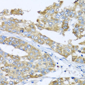 COQ7 Antibody - Immunohistochemistry of paraffin-embedded human liver cancer tissue.