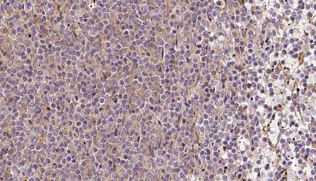 COQ9 Antibody - 1:100 staining human lymph carcinoma tissue by IHC-P. The sample was formaldehyde fixed and a heat mediated antigen retrieval step in citrate buffer was performed. The sample was then blocked and incubated with the antibody for 1.5 hours at 22°C. An HRP conjugated goat anti-rabbit antibody was used as the secondary.