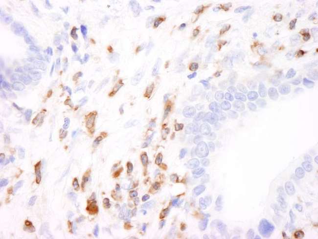 CORO1A / Coronin 1a Antibody - Detection of Human Coronin 1 by Immunohistochemistry. Sample: FFPE section of human stomach carcinoma. Antibody: Affinity purified rabbit anti-Coronin 1 used at a dilution of 1:1000 (0.2 ug/ml). Detection: DAB.