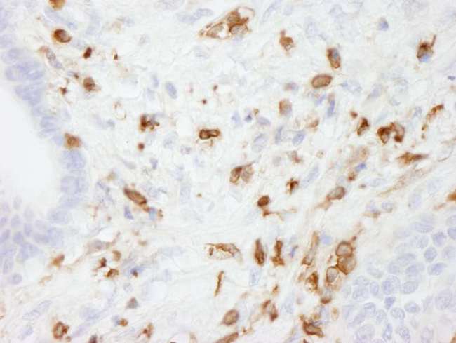 CORO1A / Coronin 1a Antibody - Detection of Human Coronin 1 by Immunohistochemistry. Sample: FFPE section of human stomach adenocarcinoma. Antibody: Affinity purified rabbit anti-Coronin 1 used at a dilution of 1:250.