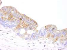 CORO1B Antibody - Detection of Human Coronin 2 by Immunohistochemistry. Sample: FFPE section of human ovarian carcinoma. Antibody: Affinity purified rabbit anti-Coronin 2 used at a dilution of 1:1000 (0.2 ug/ml). Detection: DAB.