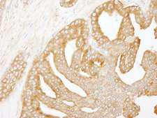 CORO1B Antibody - Detection of Human Coronin 2 by Immunohistochemistry. Sample: FFPE section of human prostate carcinoma. Antibody: Affinity purified rabbit anti-Coronin 2 used at a dilution of 1:250.