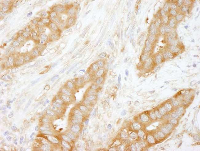 CORO1B Antibody - Detection of Human Coronin 2 by Immunohistochemistry. Sample: FFPE section of human stomach carcinoma. Antibody: Affinity purified rabbit anti-Coronin 2 used at a dilution of 1:250.