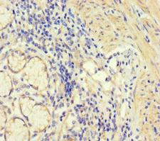 CORO1B Antibody - Immunohistochemistry of paraffin-embedded human gastric cancer at dilution of 1:100