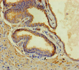 CORO1B Antibody - Immunohistochemistry of paraffin-embedded human prostate cancer at dilution of 1:100