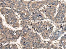 CORO1B Antibody - Immunohistochemistry of paraffin-embedded Human liver cancer tissue  using CORO1B Polyclonal Antibody at dilution of 1:40(×200)