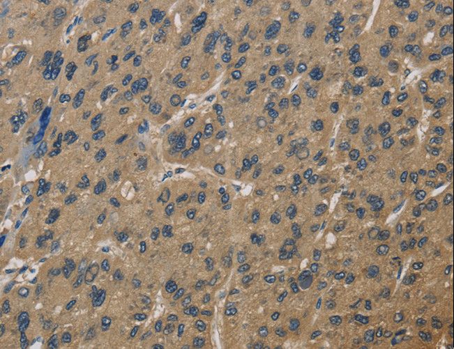 CORO1C Antibody - Immunohistochemistry of paraffin-embedded Human liver cancer using CORO1C Polyclonal Antibody at dilution of 1:60.