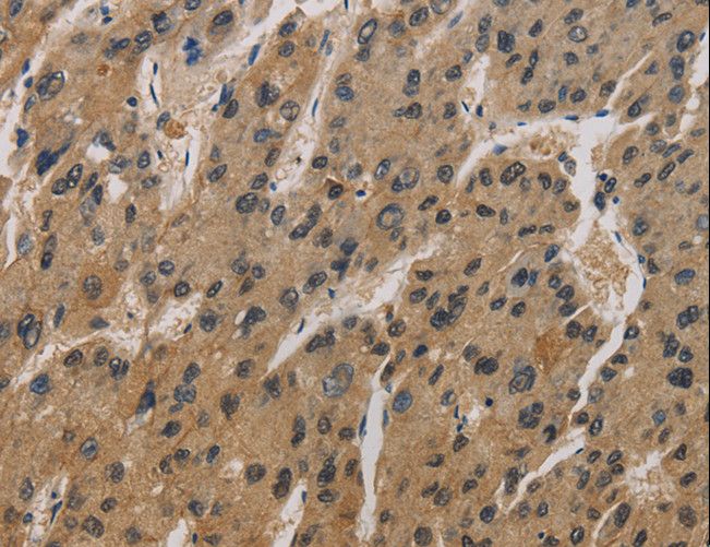 CORO1C Antibody - Immunohistochemistry of paraffin-embedded Human liver cancer using CORO1C Polyclonal Antibody at dilution of 1:50.
